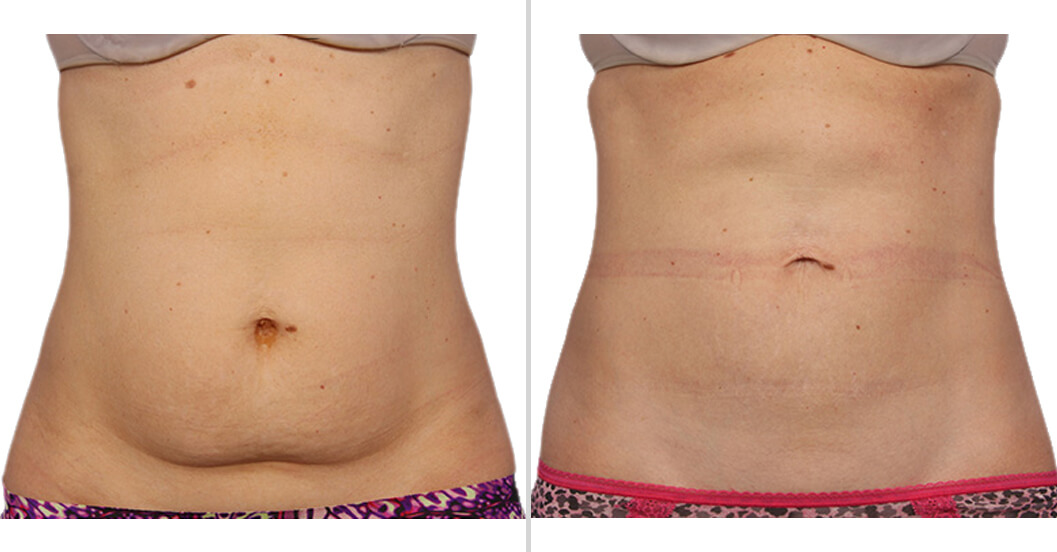 CoolSculpting Fat Removal - Style Aesthetics by RajaniMD
